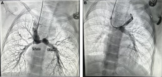 Catheterization study at 1-year follow-up (A) good flow in right BD Glenn with good arborization of the lung fields, MPA and LPA diameter mentioned (B) flow in left BG Glenn.