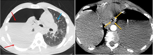 Computed tomography angiogram of the chest (lung and mediastinal window—axial computed tomography). Large left-sided hydropneumothorax (red arrows), oesophageal thickening (yellow arrows), and mediastinal shift to the right (blue arrow).