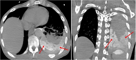 Chest computed tomography with oral contrast (axial and coronal computed tomography). Oral contrast within the left pleural space, consistent with oesophageal perforation (red arrows).