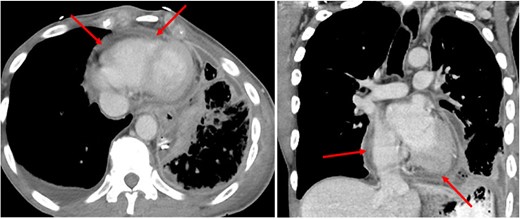 Chest computed tomography after repair of oesophageal perforation (axial and coronal computed tomography). Thickened and inflamed pericardium and pericardial fat (red arrows).