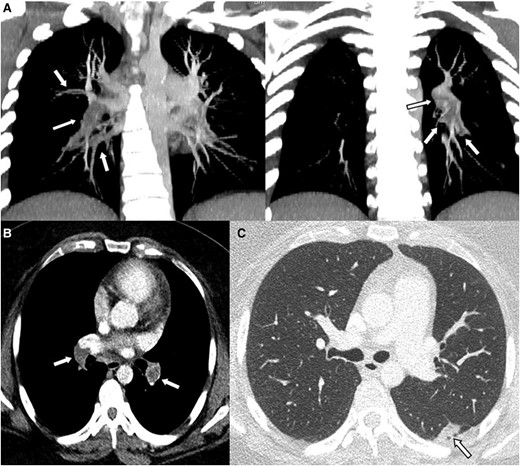 Computed tomography findings suggestive of thrombi involving both interlobar pulmonary arteries. Enhanced chest cardiac tomography revealed large thrombi causing complete obstruction in both interlobar pulmonary arteries. Additionally, smaller thrombi were observed in the segmental and subsegmental pulmonary arteries of both lower lobes and the left upper lobe (A and B). (C) also displayed evidence of a small pulmonary infarction in the left lower lobe. The arrows in panels A and B indicate thrombus, while the arrow in panel C points to the area of pulmonary infarction.