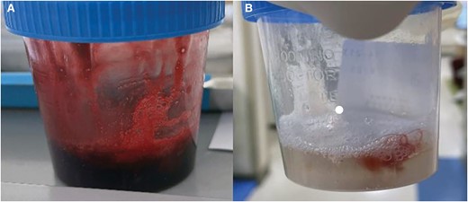 Gross findings of haemoptysis at (A) initial and (B) after surgery. After surgery, the colour of the haemorrhage gradually lightened, and eventually, only old blood clots were discharged, even after the resumption of anticoagulation therapy.