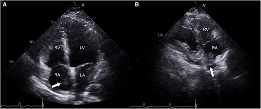 Echocardiographic findings. (A) Apical four-chamber view. (B) Right ventricular inflow view. Note the presence of an oscillating echogenic mass (presented as arrows) at the junction of the inferior vena cava and right atrium (A and B). LA, left atrium; LV, left ventricle; RA, right atrium; RV, right ventricle.