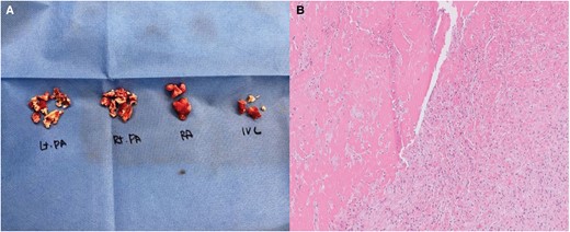 Surgical specimen (A) and histologic findings (B). (A) exhibits the surgical specimen, revealing organized white thrombi present in the pulmonary artery, right atrium, and inferior vena cava. In (B), the histological analysis of this specimen revealed that the specimens primarily consisted of thrombi composed of accumulated fibrin, some displaying characteristic lines of Zahn. These lines, indicative of thrombus formation in rapid arterial blood flow, exhibit laminations resulting from successive platelet and fibrin deposition (pale layers) alternating with red blood cells (dark layers). Sections from the left pulmonary artery and inferior vena cava thrombi displayed signs of fibroblast infiltration and focal recanalization, signifying organization. Initially, the right atrium and right pulmonary artery thrombi appeared fibrin rich. However, upon complete slide preparation of the remaining specimens, localized signs of organization were also observed. IVC, inferior vena cava; PA, pulmonary artery; RA, right atrium.