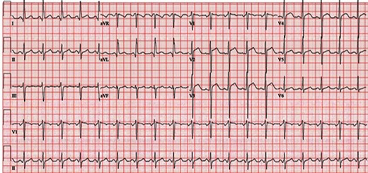 Electrocardiogram performed on initial presentation showing sinus tachycardia (120 b.p.m.) and J-point and ST elevation in precordial leads V2–V4.