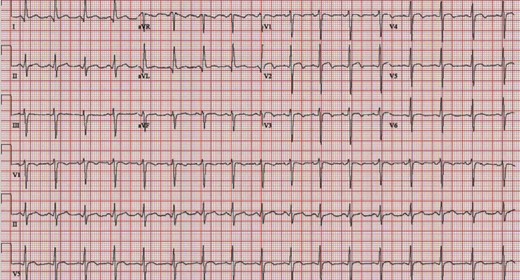 Electrocardiogram on first rupture showing sinus tachycardia (104 b.p.m.) and J-point and ST elevation in precordial leads V2–4 with T-wave inversion in V1–V4.