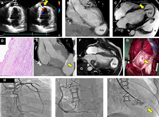 (A) TTE apical two-chamber view (first rupture) shows apical PsA and colour Doppler demonstrates to-and-fro flow (arrow). (B) CTA (first rupture), in the coronal view, shows contrast collection (PsA) at the LV apex. (C) CMR (1.5 T) SSFP sequence four-chamber image (first rupture) showing a large (55 × 39 mm) apical PsA with dephasing signal from flow into the PsA cavity (arrow) and a large left pleural effusion (asterisk). (D) Histopathological examination (first rupture) with H&E stain shows no evidence of vasculitis or myocarditis. (E) CTA shows recurrent PsA (second rupture). There are also calcifications noted (arrow) at the prior surgical repair site. (F) Six months later (second rupture), the patient had the development of a new PsA cavity (67 × 52 mm) adjacent to the site of surgical repair of the initial rupture. (G) Apical defect (15 mm) seen during the second rupture after evacuation of the haematoma. (H and I) Coronary angiography (third rupture) shows normal left and right coronary arteries. (J) An Amplatzer occluder (12 mm) was successfully implanted to seal the defect in the LV apex during the third rupture (arrow). TTE, transthoracic echocardiogram; PsA, pseudoaneurysm; LV, left ventricular; CTA, computed tomography angiography; CMR, cardiovascular magnetic resonance; SSFP, steady-state free precession; H&E, haematoxylin and eosin; LM, left main; LAD, left anterior descending artery; LCx, left circumflex artery; RCA, right coronary artery.