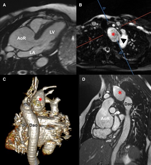 Cardiovascular magnetic resonance imaging without contrast at 21 weeks of gestation. Three-chamber view showing the enlarged aortic root (A). Quiescent-interval slice-selective (QISS) (B, C) and cine MRI (D) demonstrating the subclavian artery aneurysm (star) and the origin of the aberrant right subclavian artery (arrowhead). AoR, aortic root; Dao, descending aorta; LA, left atrium; LV, left ventricle; RV, right ventricle.