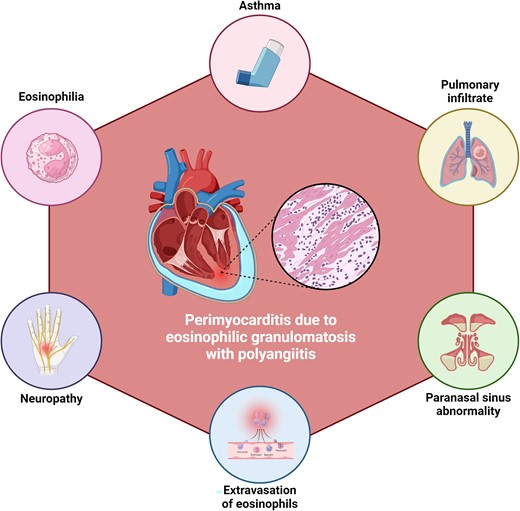 Characteristics of eosinophilic granulomatosis with polyangiitis that can hint towards its diagnosis in patients with perimyocarditis.