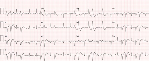 Electrocardiogram at admission. The electrocardiogram showed sinus tachycardia with frequent non-sustained ventricular tachycardia originating from the left ventricle. Q waves were also present in leads III and aVF. This is a right bundle branch superior axis ventricular tachycardia, consistent with origin of ventricular tachycardia from the anterior papillary muscle.