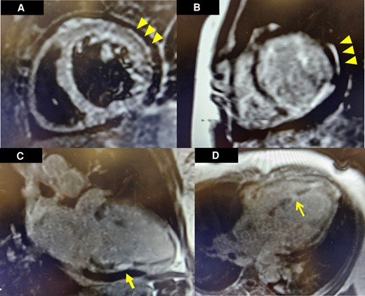 Cardiac magnetic resonance imaging findings. Subepicardial oedema can be visualized in the basal anterolateral segment of the left ventricle in T2 short-tau inversion recovery imaging (A). On post-contrast T1-prepared images, late gadolinium enhancement was observed in a corresponding and similar distribution of the basal anterolateral segment (B). Additional full thickness late gadolinium enhancement was noted in the midsegment of the inferior wall in a two-chamber view (C). Full thickness late gadolinium enhancement was noted in the mid inferoseptal segment of the left ventricle in a four-chamber view (D).