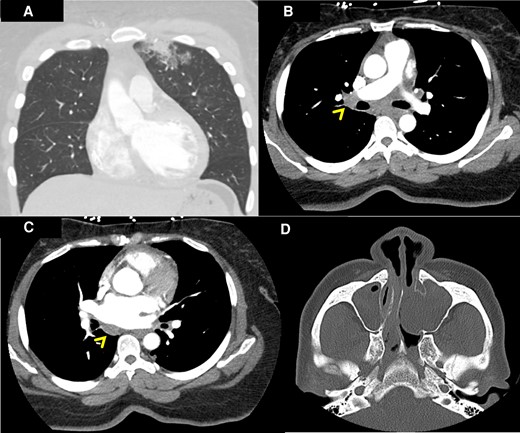 Computed tomography of the chest and sinuses. Patchy bilateral ground glass and airspace opacities were noted in the left upper lobe on computed tomography of the chest with intravenous contrast (A). Mediastinal lymphadenopathies were also visualized (linear arrowheads in B and C). Left antrochoanal polyp was found on computed tomography of the sinuses with intravenous contrast (D).