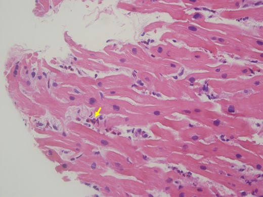 Endomyocardial biopsy. Haematoxylin and eosin stain of the endomyocardial biopsy shows infiltration of eosinophils (arrow) in the endomyocardium.