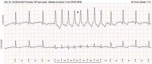 Episode of broad complex tachycardia (arrow) lasting 8 beats at 187 b.p.m. triggered by R on T on Holter electrocardiogram monitor.