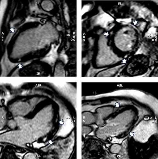 Cardiac magnetic resonance imaging showing multiple areas of late gadolinium enhancement seen at the mid–interventricular septum, sub-epicardium mid-wall of the lateral wall with focal thinning of the mid-lateral wall (arrows).