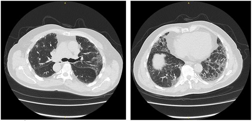 High-resolution chest computed tomography showing nonspecific interstitial pneumonia pattern of interstitial lung disease commonly related to connective tissue diseases.