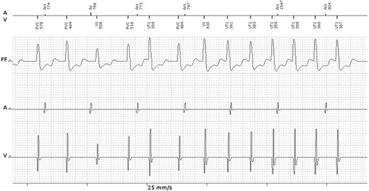 Episode of non-sustained ventricular tachycardia detected by the implantable cardioverter-defibrillator device.