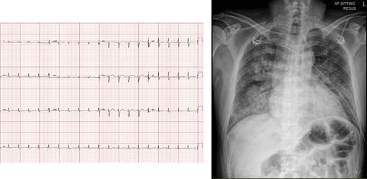 (Left) Initial electrocardiogram showing sinus tachycardia and no ischaemic changes. (Right) Chest X-ray on presentation, showing pulmonary congestion.