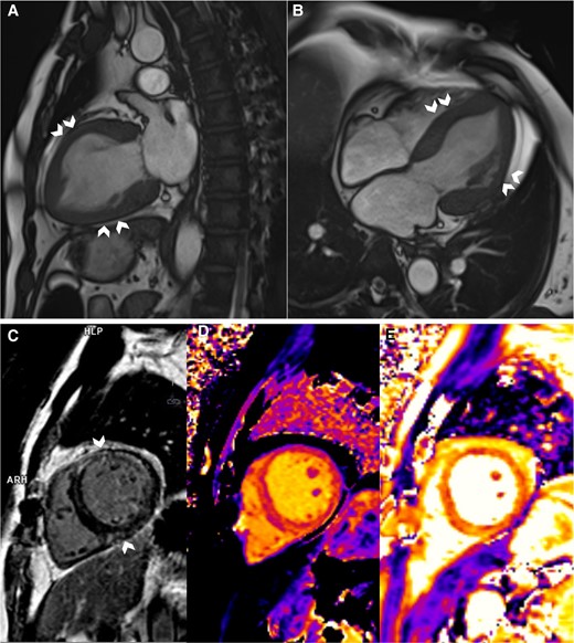 Cardiac magnetic resonance imaging. (A and B) Systolic frames of cine images showing akinesia of the mid-segments, i.e. mid-anterior, septal, lateral, and inferior (chevron arrows), and normokinesia of the basal and apical segments. (C) Mid-wall Late Gadolinium enhancement at the mid-anterior, anteroseptal, anterolateral, and inferior (chevron arrows) segments. (D and E) Parametric mapping of the corresponding slice, showing increased global native T1 (D) and T2 (E) relaxation times, implying the presence of oedema.