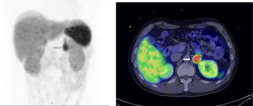 68Ga-68 DOTATATE scan showing avid tracer uptake by the left phaeochromocytoma (indicated by the arrows).