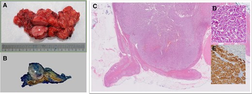 (A) Gross surgical specimen. Phaeochromocytoma (round, fleshy mass, asterisk) with adjacent normal adrenal structures and surrounding fat. (B) Phaeochromocytoma (well-circumscribed, cream-coloured mass, asterisk) arising from the medulla. The normal adrenal cortex appears dark yellow and the normal medulla appears brown. (C) Low power H&E specimen. Nodular mass (purple) involving the medulla of the adrenal gland. A small amount of normal adrenal gland is present (bright pink). (D) High-power H&E specimen. The tumour has a Zellballen (German for ball of cells) pattern, large and ovoid nuclei with nucleoli, and abundant granular cytoplasm. (E) Tumour expressing neuroendocrine markers, i.e. synaptophysin and chromogranin positive. Note that the normal adrenal cortex in the right upper corner is stained negative.