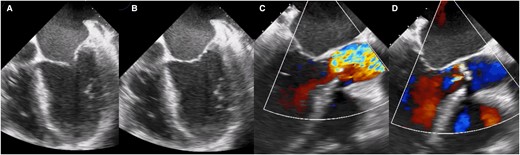 Transoesophageal echocardiogram showing the left ventricle with decreased generalized mobility, (A) ventricular systole, (B) ventricular diastole, (C) turbulent flow secondary to valve obstruction is observed, and (D) mild aortic insufficiency.