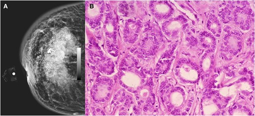 (A) Mammography showing a dense mass, heterogeneous, with calcification, with poorly delimited and speculated edges. (B) Microscopic image with epithelial neoplastic lesion growing in the ducts with moderate pleomorphism, consistent with invasive ductal carcinoma with a specific pattern.
