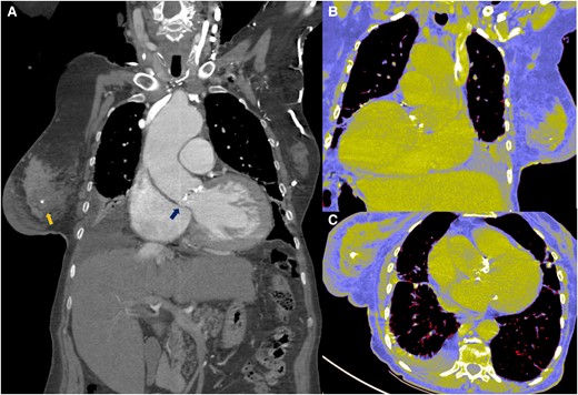 (A–C) Tomographic image where both pathologies are observed. Breast tumour and aortic stenosis (arrows).