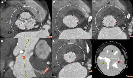 Tomographic planning. (A) sinuses of Valsalva, (B) aortic annulus in systole, (C) annulus in diastole, (D) no-coronary sinus, (E) outflow tract and, (F) degree of moderate calcification. LC sinus, left coronary; RC sinus, right coronary; NC sinus, Non coronary. 1, Right-left commissure; 2, non coronary sinus; 3, left coronary sinus; 4, right coronary sinus.