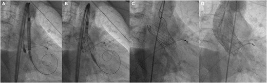 Interventional procedure. (A and B) Valve alignment, (C) complete release of the valve, and (D) control aortography, with adequate position and absence of paravalvular leak.