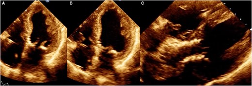 Control echocardiogram 3 months after the procedure. (A) Ventricular systole, (B) ventricular diastole, and (C) image of the percutaneous valve in a modified 5-chamber projection.