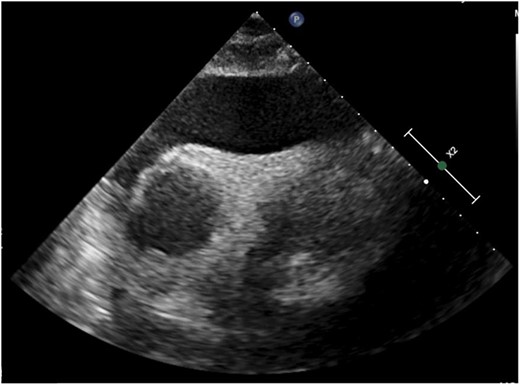 2D echocardiogram (subcostal view) demonstrating massive pericardial effusion.