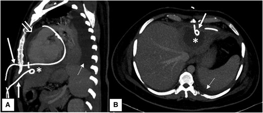 Computed tomography scan. Sagittal (A) and axial (B) maximum intensity projection contrast-enhanced computed tomography images of the patient showing two pigtail drainage catheters in situ inserted by subcoastal approach. The upper one (long white arrow) was inserted left lateral to xiphisternum and directly entering into the pericardial cavity. The lower one (short white arrow) was inserted below the level of xiphisternum and draining the hypodense hepatic abscess (asterisk) in segment II of left lobe of liver. Note made of associated pericardial collection with enhancing parietal pericardial lining (open white arrow) and left-sided pleural effusion (dashed white arrow).