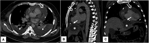Axial (A), sagittal (B), and coronal (C) contrast-enhanced computed tomography images showing a hypodense pericardial collection with an enhancing parietal pericardial lining (open white arrow) and bilateral pleural effusion (dashed white arrow) with underlying basal lung collapse. Peripherally enhancing hypodense subcapsular hepatic abscess (asterisk) in left lobe segment II, rupturing into the pericardial cavity via a small defect (short white arrow) through the diaphragm.