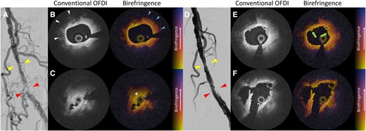 (A) Pre-angiogram. (B) Intravascular polarimetry images before excimer laser atherectomy at the proximal part of the in-stent restenosis (cross-section shown by yellow triangles in A). (C) Intravascular polarimetry images before excimer laser atherectomy at the distal part of the in-stent restenosis (cross-section shown by red triangles in A). (D) Angiogram after excimer laser atherectomy. (E) Intravascular polarimetry images after excimer laser atherectomy at the proximal part of the in-stent restenosis (cross-section shown by yellow triangles in D). (F) Intravascular polarimetry images after excimer laser atherectomy at the distal part of the in-stent restenosis (cross-section shown by red triangles in D). OFDI, optical frequency domain imaging.