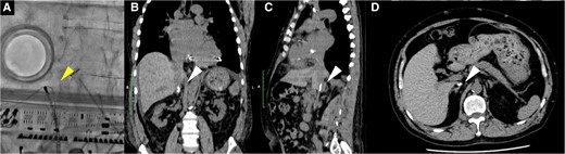 Fluoroscopy (A) and computed tomography (B–D) revealed that both the radiofrequency ablation catheter and the 0.035 in spring coil wire could not advance from the femoral vein to the right atrium due to calcified venous thrombosis blocking the inferior vena cava at the renal vein level. The white arrowhead indicates the radiofrequency ablation catheter and the 0.035 in spring coil wire, while the white arrowhead shows calcified venous thrombosis.
