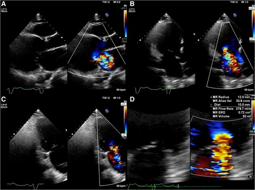 Preprocedural transthoracic echocardiography images show severe mitral regurgitation from A2/P2 (A–C). The quantification of mitral regurgitation by the Proximal Isovelocity Surface Area method showed an effective regurgitant orifice area of 72 mm2 and a regurgitant volume of 92 mL (D).