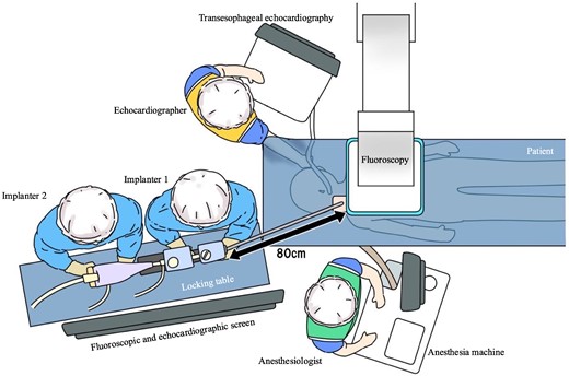 Schematic illustration of room setup for transcatheter edge-to-edge mitral valve repair via the right internal jugular vein. This approach positions the implanters at the patient’s head on their right side, with an additional table 80 cm from the chest for the MitraClip stabilizer and display screens for fluoroscopy and transoesophageal echocardiography in front of the physicians. A locking table is essential for the stabilizer. The echocardiographer is positioned on the patient’s left, while the anaesthetist is at the foot of the bed.