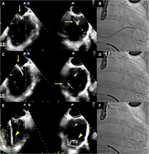 Transoesophageal echocardiography images (A, C, and E) and concurrent fluoroscopy images (B, D, and F) are shown. The left-side images display the bicommissural view, while those on the right side illustrate the left ventricular outflow tract view in transoesophageal echocardiography. Guided by transoesophageal echocardiography, a 5-French pigtail catheter was advanced through the mitral valve at the A2/P2 scallop into the left ventricle using a coil wire (A, bicommissural view, and B), ensuring it did not entangle with the chordae tendineae as it was directed towards the apex (C and D). The catheter was subsequently replaced with a Confida wire, and the tip was confirmed at the apex, enabling the safe insertion of the guiding catheter (E and F). In the transoesophageal echocardiography images, the arrow identifies the pigtail catheter, while the arrowhead points to the Confida wire.