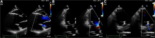 Postprocedural transthoracic echocardiography images showed mild residual mitral regurgitation (A–C).
