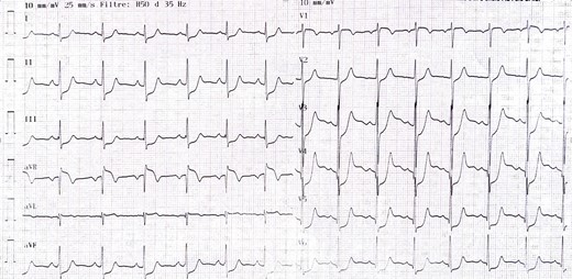 Twelve-lead rest electrocardiogram at admission in the chest pain unit.