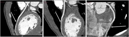 Coronary computed Tomography scan. The white arrows show the myocardial bridging on the left anterior descending coronary artery.