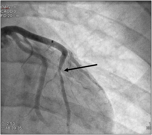 Coronary angiogram, caudal view. The black arrow shows the myocardial bridging on the left anterior descending coronary artery with a systolic compression of the lumen > 50%.