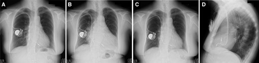 Chest X-ray images after pacemaker implantation (A), when heart failure developed 6 years later due to pacing-induced cardiomyopathy (B), and 6 months after cardiac resynchronization therapy pacemaker upgrade in frontal view (C) and lateral view (D). CS, coronary sinus; CRT-P, cardiac resynchronization therapy pacemaker; PLSVC, persistent left superior vena cava.