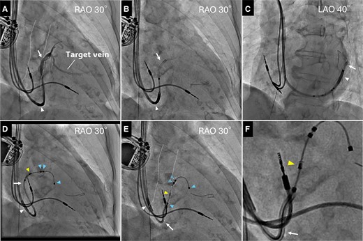 A subselection catheter (white arrow) was cannulated into the lateral vein and backed up with a guiding catheter (white arrowhead). A contrast from the catheter showed that the target vein was steeply bent and stenotic at the end of the bend (A). The guidewire crossed the flexure and deep into the lateral vein in right anterior oblique (B), and left anterior oblique view (C). Attain Stability Quadripolar lead (blue arrowheads) was delivered into the lateral vein over the wire but could not pass over the bent stenosis, and the subselection catheter was pushed out when the lead was attempted to advance (D). A subselection catheter was pulled to expose the third and fourth electrodes, and the side helix (yellow arrowhead) between them was pressurized against the anterior wall of the dilated coronary sinus using the distal end curve of the catheter (E). The lead was successfully anchored to this location by clockwise rotating the lead body. Enlarged image of E (F). CS, coronary sinus; LAO, left anterior oblique; RAO, right anterior oblique.