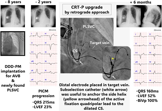 AP, anteroposterior; AVB, atrioventricular block; BiVp, biventricular pacing; CRT-P, ardiac resynchronization therapy pacemaker; CS, coronary sinus; LVEF, left ventricular ejection fraction; PICM, pacing-induced cardiomyopathy; PLSVC, persistent left superior vena cava; PM, pacemaker; RAO, right anterior oblique.
