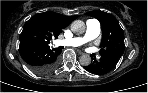Initial computed tomography scan of the chest showing the predominantly high peripheral thrombus burden.