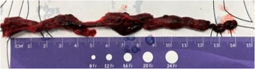 Retrieved, 14 cm long clot-in-transit.