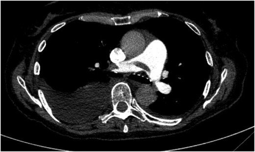 Computed tomography scan revealed repeated pulmonary embolism with progressive central and peripheral thrombus burden.