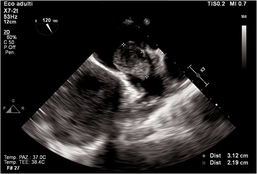 Transoesophageal echocardiogram mid-oesophageal view at 120°. The figure shows a huge mass in the left atrial appendage.
